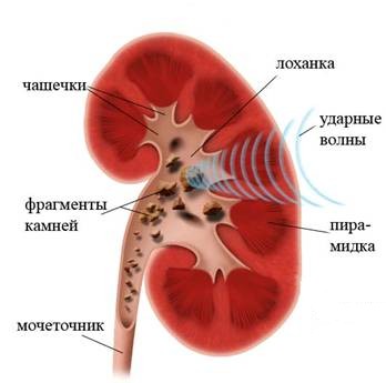 конкременты