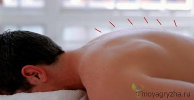 иглоукалывание