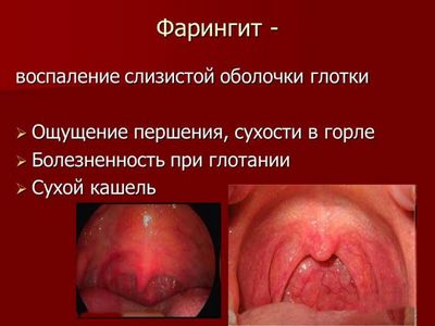 фарингит фарингит