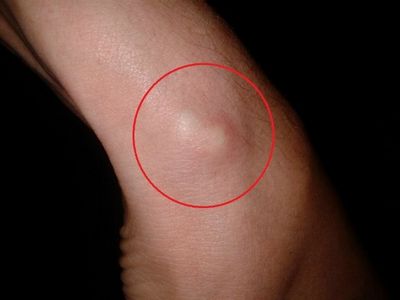 кисты ганглия