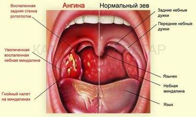 ангина