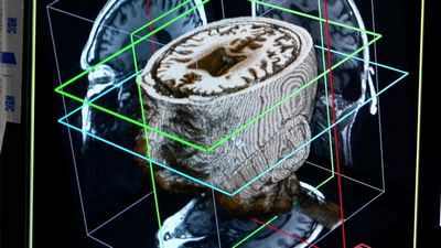 ИИ может обнаружить деменцию за годы до появления симптомов