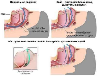 Апноэ во сне может повысить риск для пациентов, перенесших ангиопластику