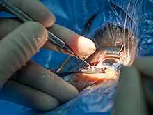 Катаракта увеличивает вероятность депрессии у пожилых людей